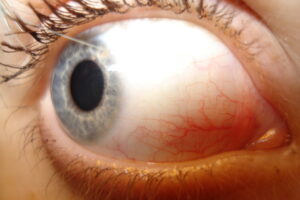 Conjuntiva